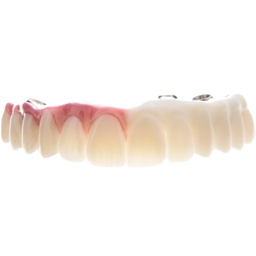 Carillas y coronas impresas en resina dental