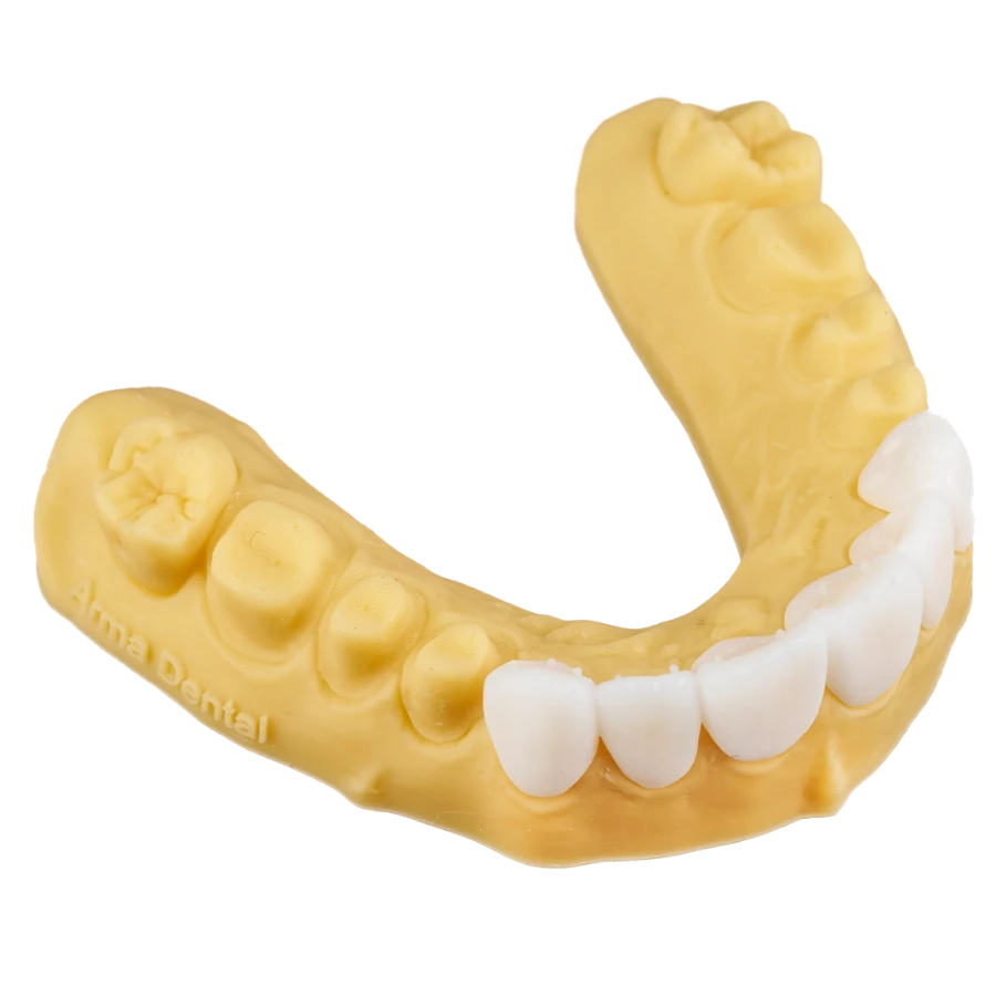 Provisionales dentales impresos en 3D