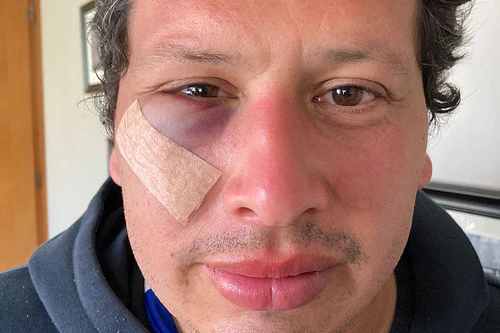 UNA CAÍDA EN BICI O UN CODAZO PERFECTO
