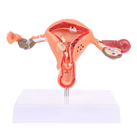 Modelo Anatómico Útero Y Ovarios Patológicos