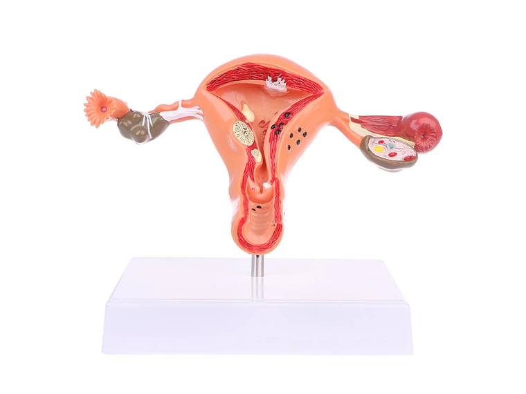 Modelo Anatómico Útero Y Ovarios Patológicos 1