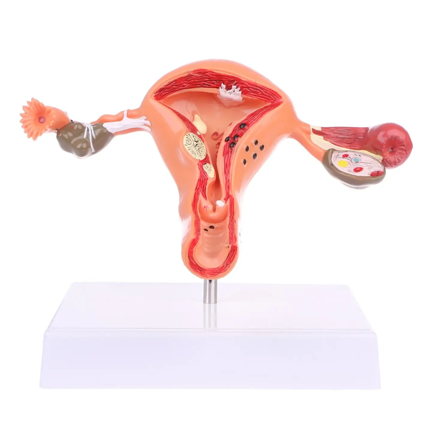 Modelo Anatómico Útero Y Ovarios Patológicos 1