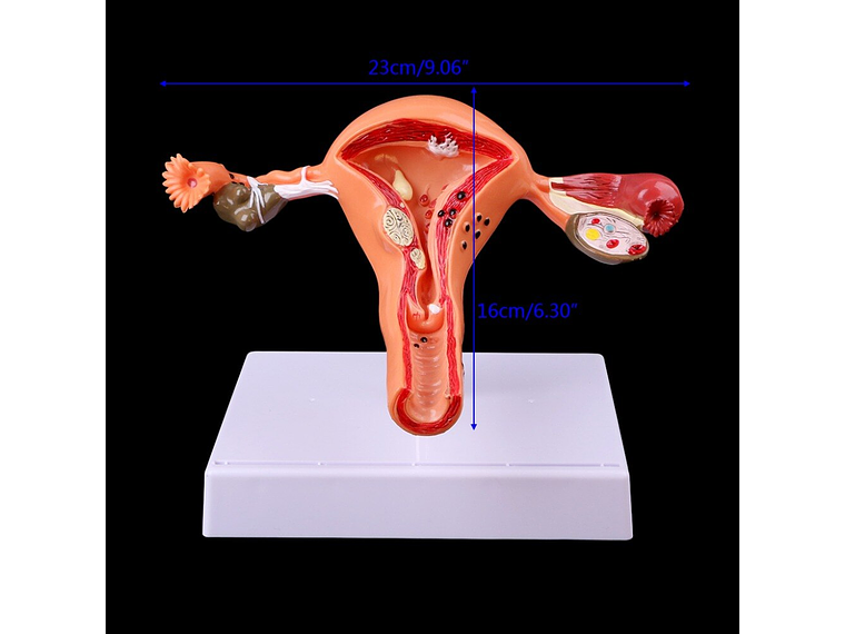Modelo Anatómico Útero Y Ovarios Patológicos 3