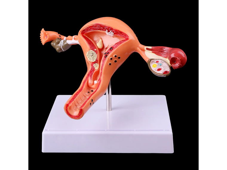 Modelo Anatómico Útero Y Ovarios Patológicos 8