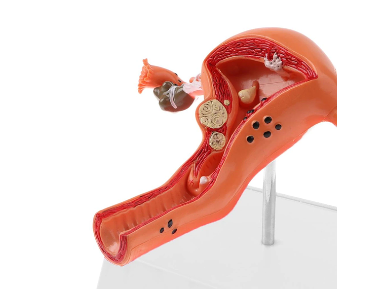 Modelo Anatómico Útero Y Ovarios Patológicos 11