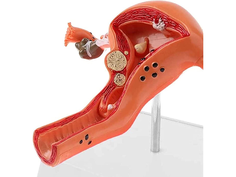 Modelo Anatómico Útero Y Ovarios Patológicos 12