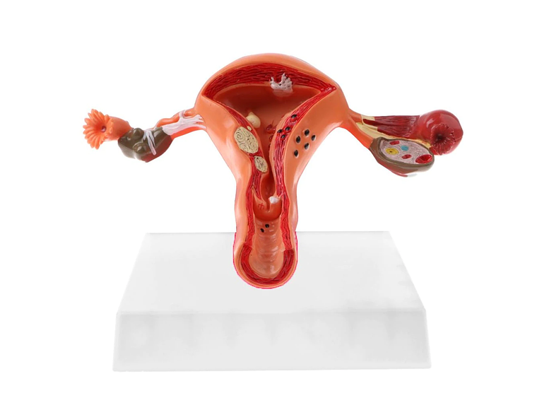 Modelo Anatómico Útero Y Ovarios Patológicos 16