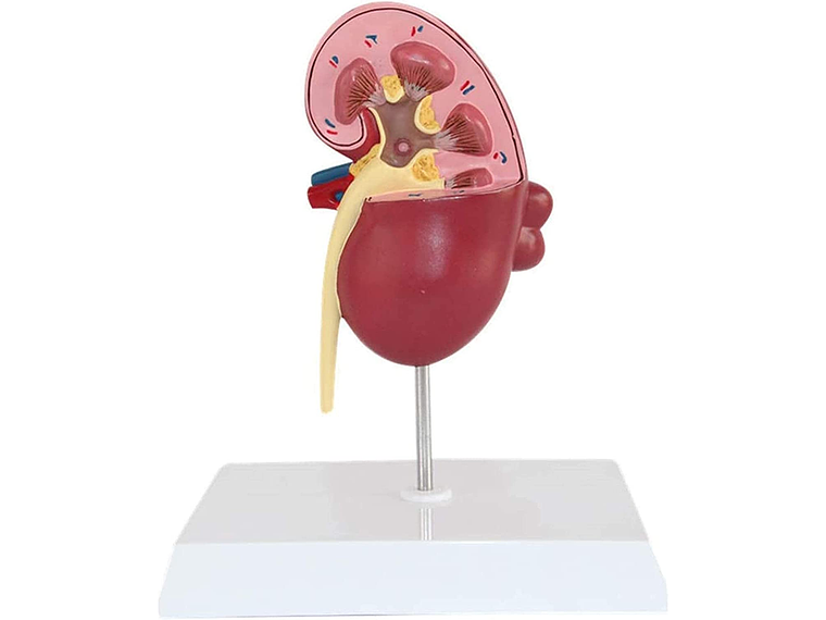 Modelo Anatómico Riñón Patologías 1