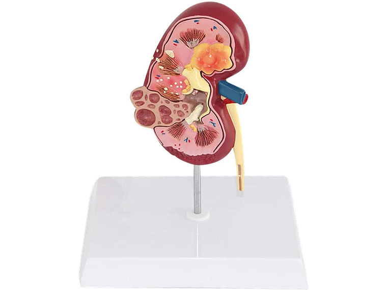Modelo Anatómico Riñón Patologías 2