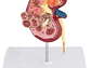 Modelo Anatómico Riñón Patologías - Miniatura 2