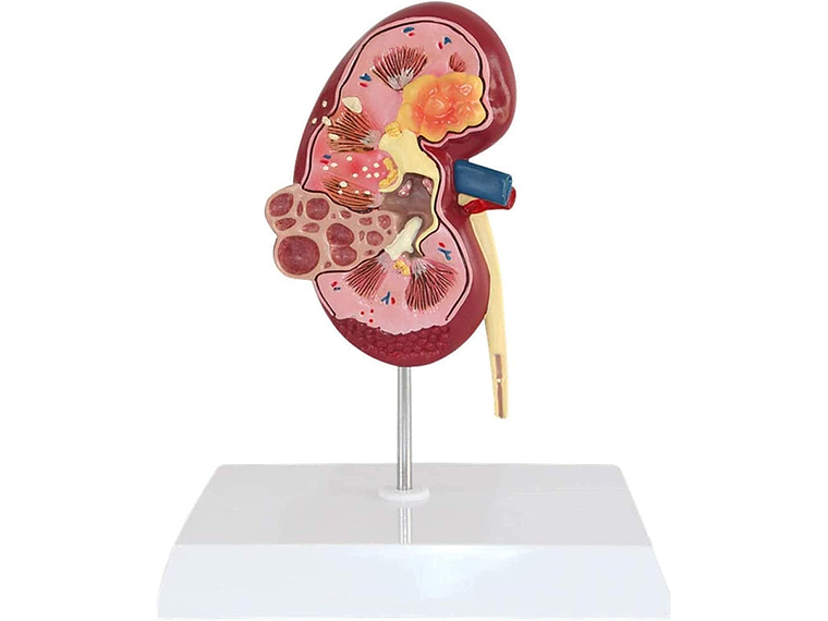 Modelo Anatómico Riñón Patologías 3