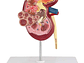 Modelo Anatómico Riñón Patologías - Miniatura 3
