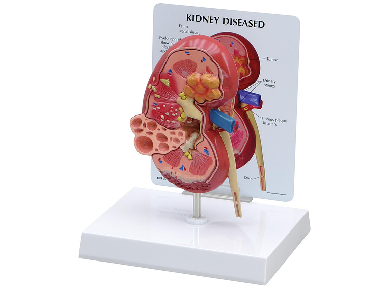 Modelo Anatómico Riñón Patologías 4