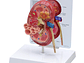 Modelo Anatómico Riñón Patologías - Miniatura 4