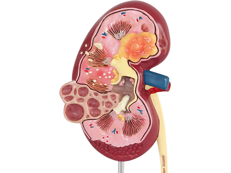 Modelo Anatómico Riñón Patologías 5