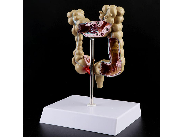 Maqueta Modelo Anatómico Colon Recto Patologías Más Comunes 2