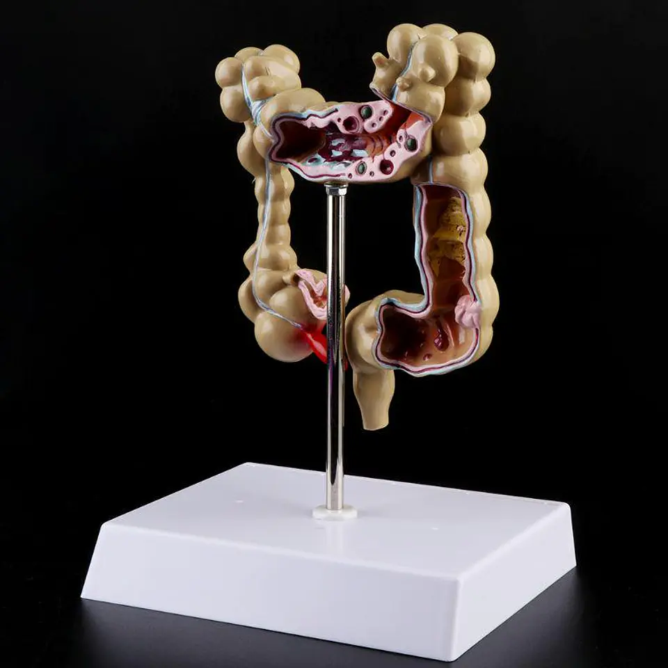 Maqueta Modelo Anatómico Colon Recto Patologías Más Comunes 2