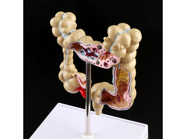 Maqueta Modelo Anatómico Colon Recto Patologías Más Comunes 4