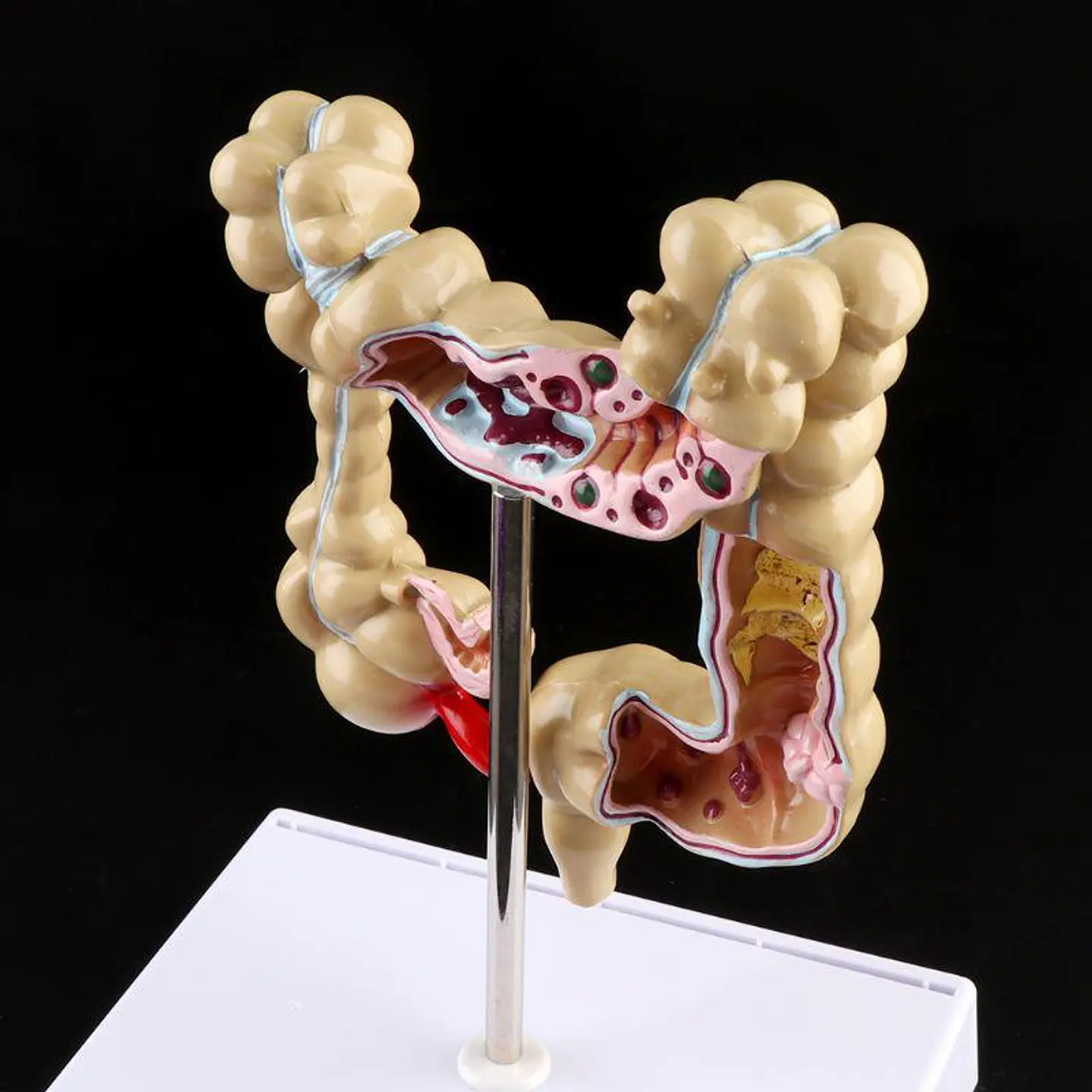 Maqueta Modelo Anatómico Colon Recto Patologías Más Comunes 4