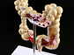 Maqueta Modelo Anatómico Colon Recto Patologías Más Comunes - Miniatura 4
