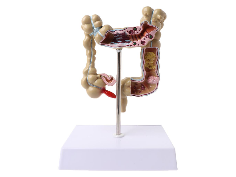 Maqueta Modelo Anatómico Colon Recto Patologías Más Comunes 1
