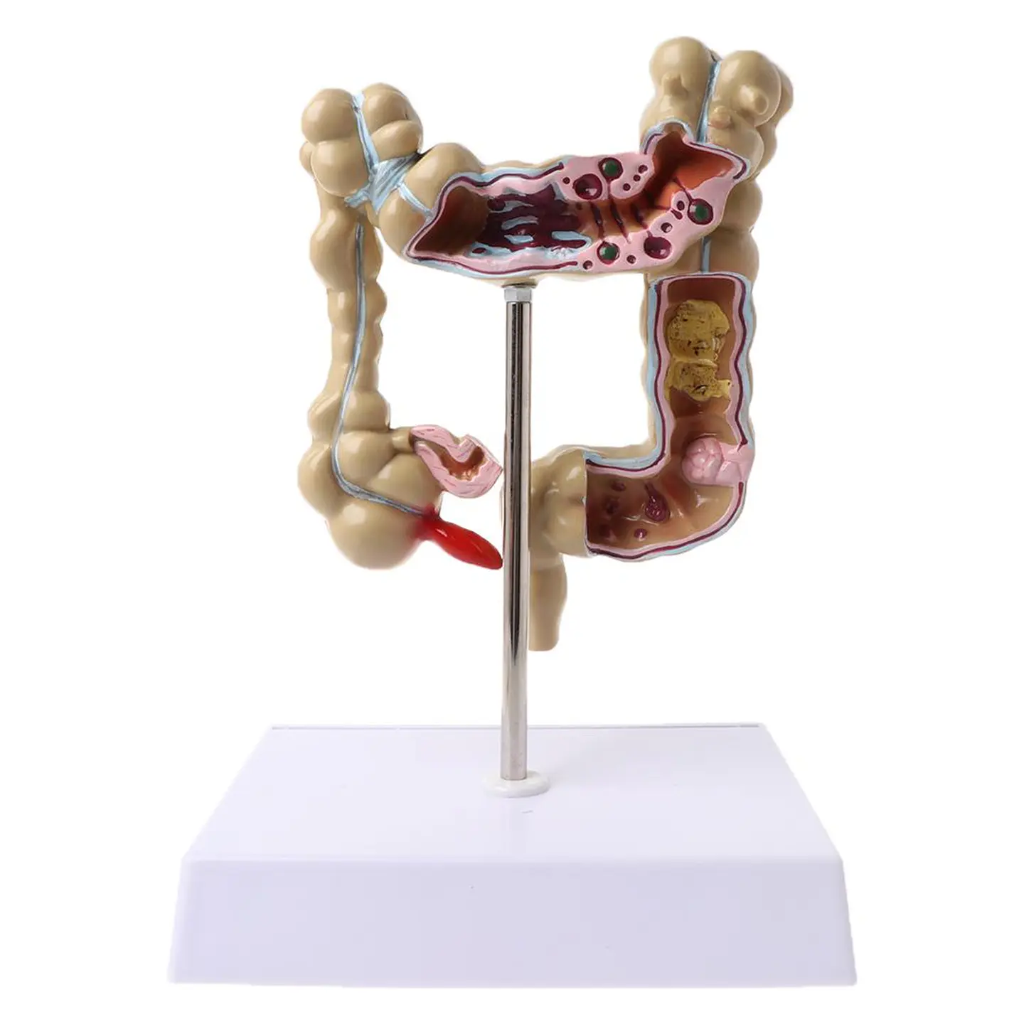 Maqueta Modelo Anatómico Colon Recto Patologías Más Comunes 1