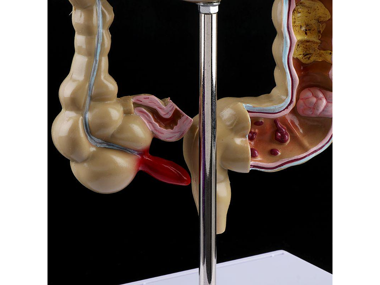 Maqueta Modelo Anatómico Colon Recto Patologías Más Comunes 5