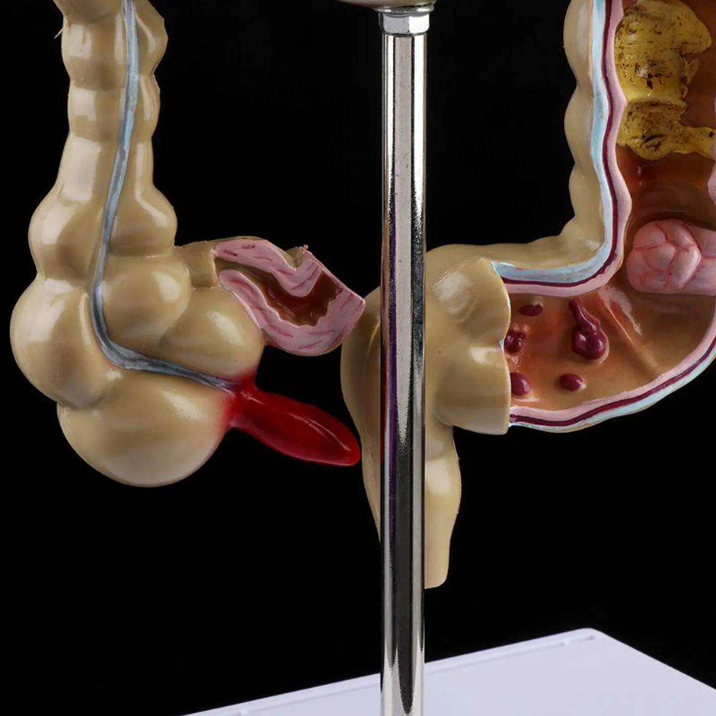 Maqueta Modelo Anatómico Colon Recto Patologías Más Comunes 5