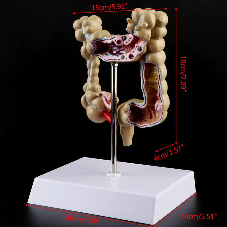 Maqueta Modelo Anatómico Colon Recto Patologías Más Comunes 6