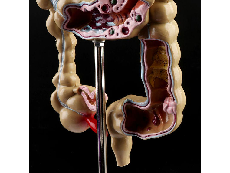 Maqueta Modelo Anatómico Colon Recto Patologías Más Comunes 7