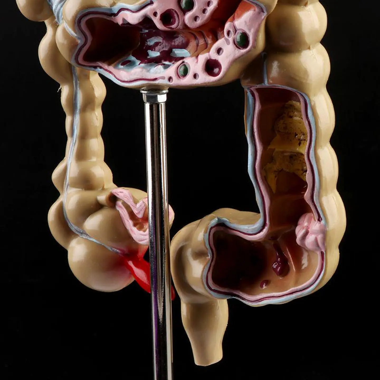 Maqueta Modelo Anatómico Colon Recto Patologías Más Comunes 7