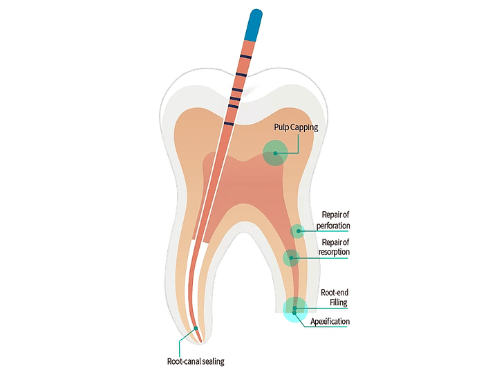 CEMENTO BIOCERAMICO SURE-SEAL ROOT 0,5GR Y 2GR 3