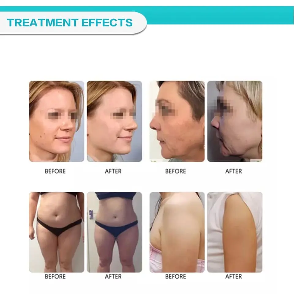 HIFU 4D + LIPOSONIX (2 EN 1) 12