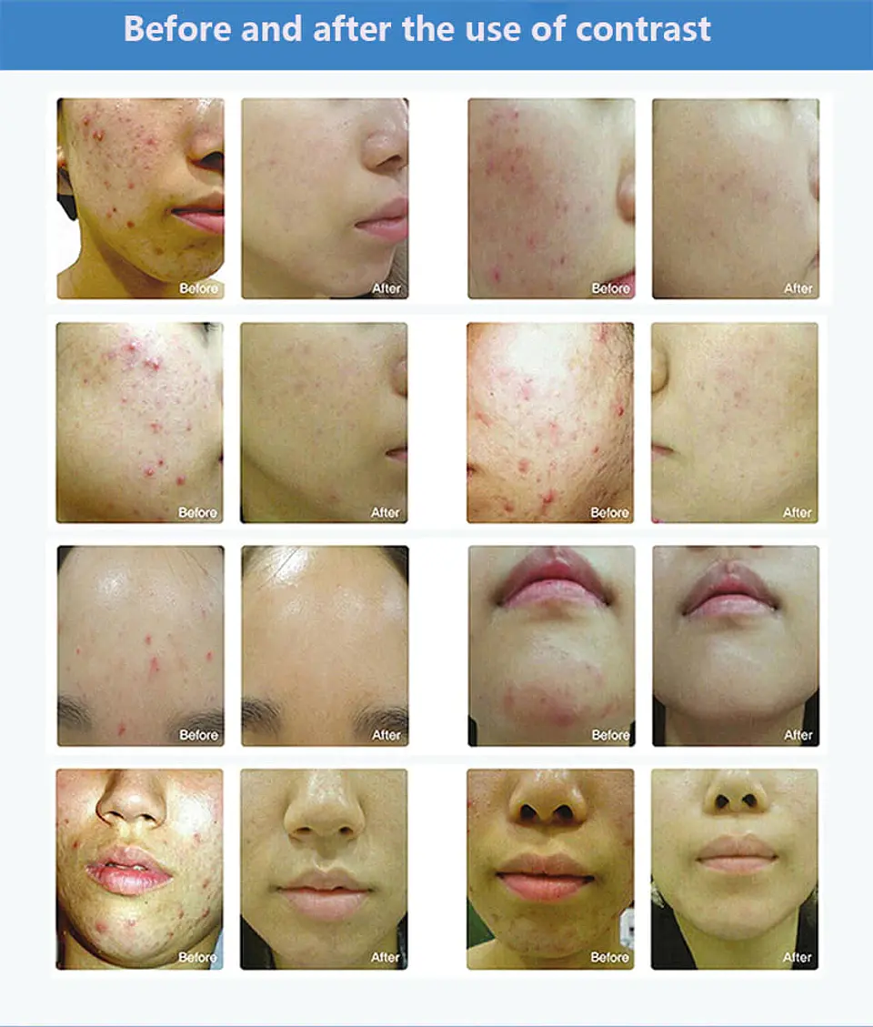 Cabina para Fototerapia Facial 7 Colores 5