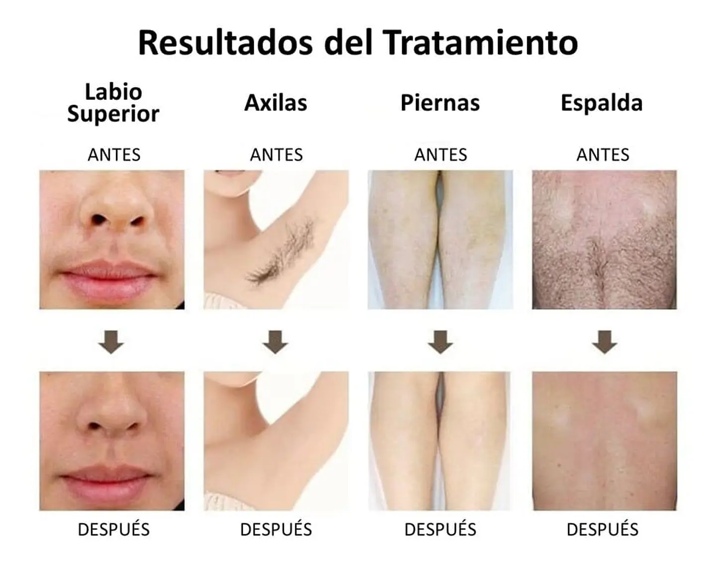 Equipo Triláser para Depilación Definitiva - 20 millones de Tiros 8