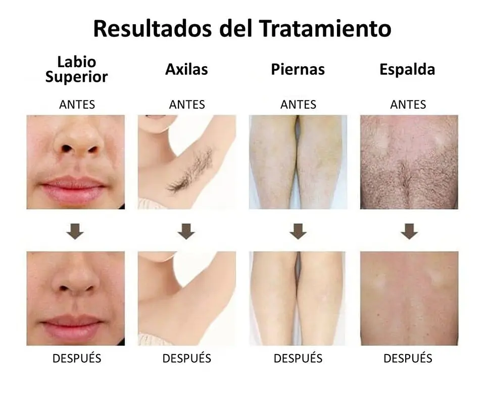 Equipo Triláser para Depilación Definitiva - 20 millones de Tiros 8