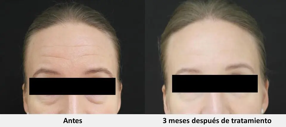 HIFU 7D (MMFU) 14