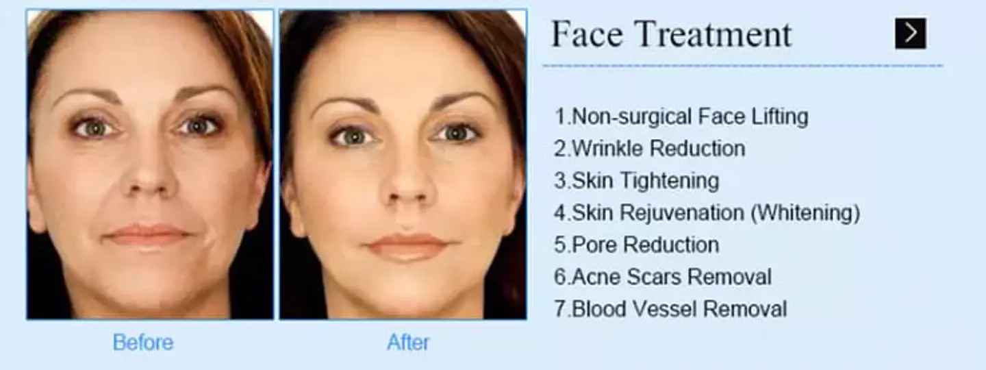 HIFU 4D + Vmax Hifu Carving + RF Fraccionada  (3 en 1) 8