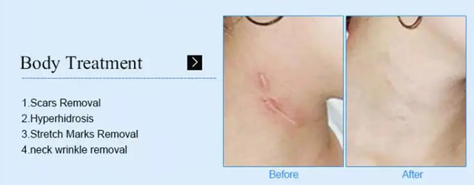 HIFU 4D + Vmax Hifu Carving + RF Fraccionada  (3 en 1) 9
