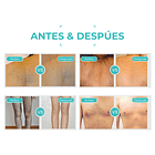 Equipo Depilación Diodo Láser Portátil 4