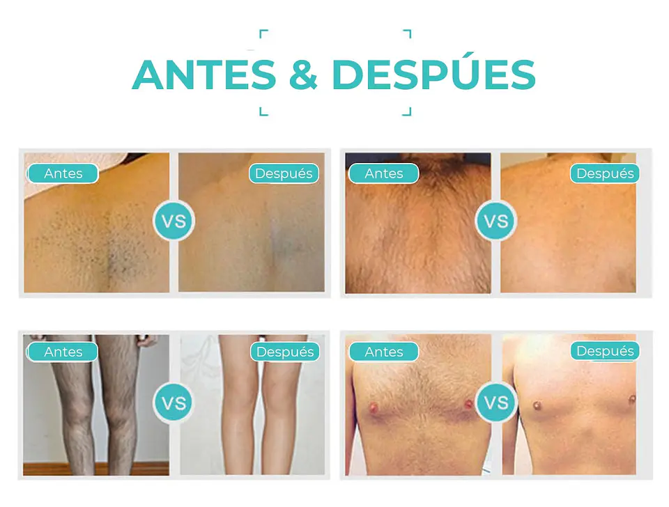 Equipo Depilación Diodo Láser Portátil 4