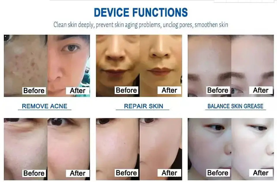 Equipo Hidrodermoabrasión para Belleza Facial - 6 en 1 8