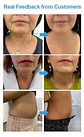 HIFU 7D Vaginal - PRO - Miniatura 12
