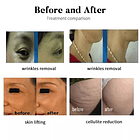 Equipo RF Cooling Monopolar Vertical  8