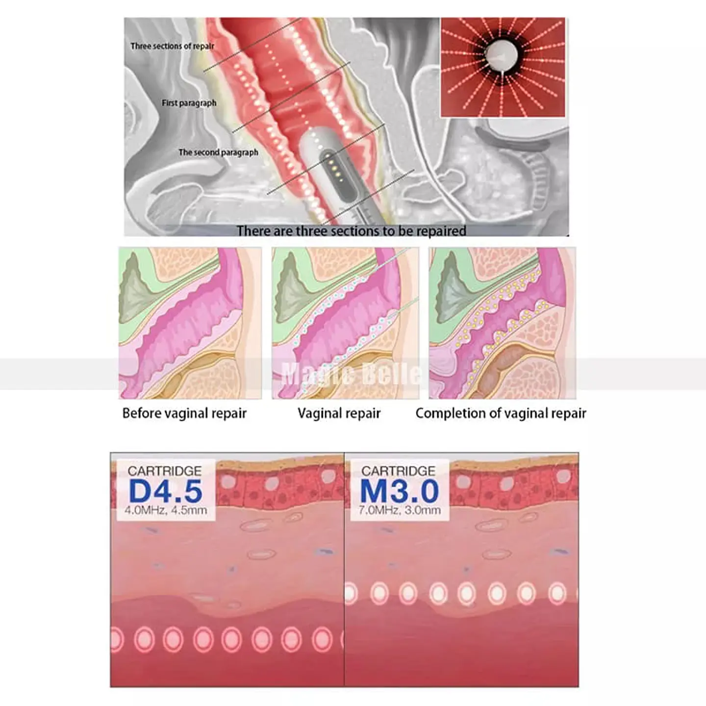 HIFU 7D + VAGINAL (Sobremesa) 10