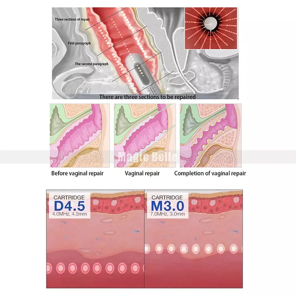 HIFU 7D + VAGINAL (Sobremesa) 10
