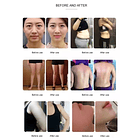 Equipo RF Monopolar/ Diatermia  RET y CET 448K  6