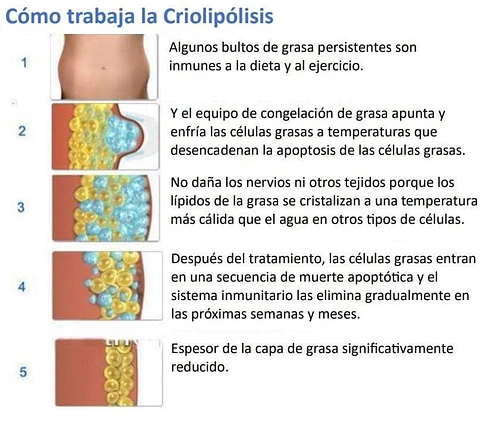 CRIOLIPOLISIS COOLMAX