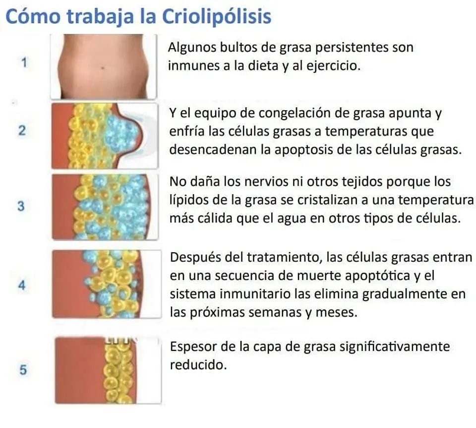 CRIOLIPOLISIS COOLMAX 2