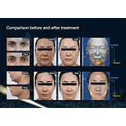 HIFU 12D MPT VERTICAL 11